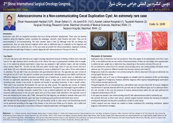 Adenocarcinoma in a Non-communicating Cecal Duplication Cyst: An extremely rare case